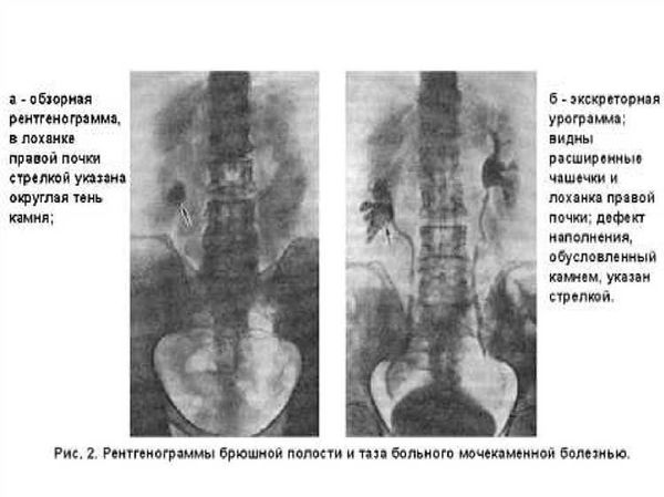 Осложнения мочекаменной болезни